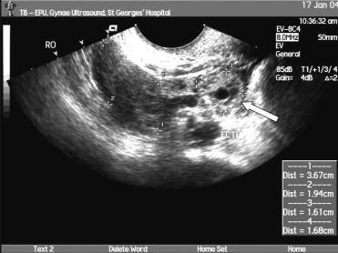 Referenser 1. Kirk E, Bottomley C, Bourne T (2014). "Diagnosing ectopic pregnancy and current concepts in the management of pregnancy of unknown location".hum. Reprod. Update20(2): 250 61 2.