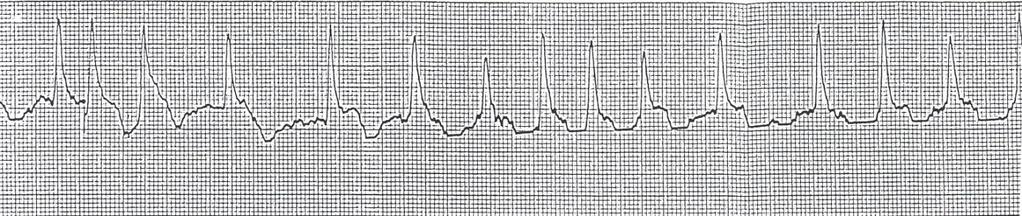 Fråga 44 Tolka rytmen på följande EKG (1