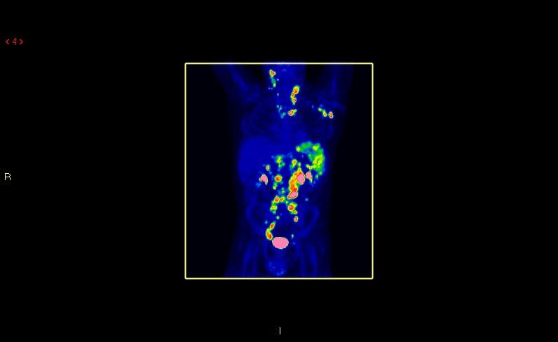 FDG-PET/CT för