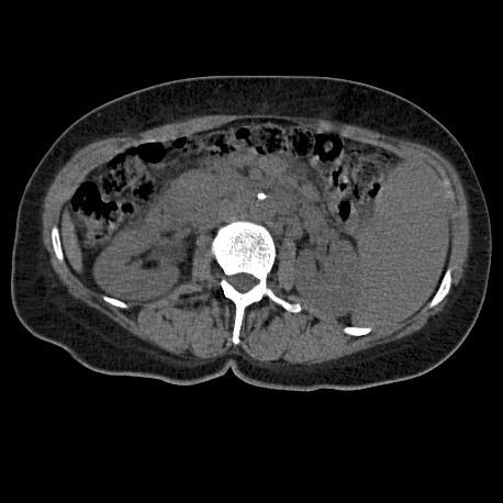 Mantelcellslymfom B-cells-lymfom, utmärks kliniskt av: Varken hög- eller lågmalignt Vanligen extranodal, spridd