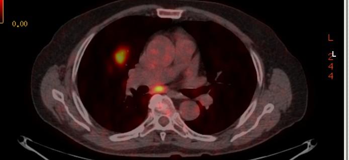 Behandling av lungcancer Stadium Resektabel tumör st IA-IIIA Lokaliserad/lokalt avancerad PS0-1, funktion ok Inoperabel pat st I-II Lokaliserad sjukdom.