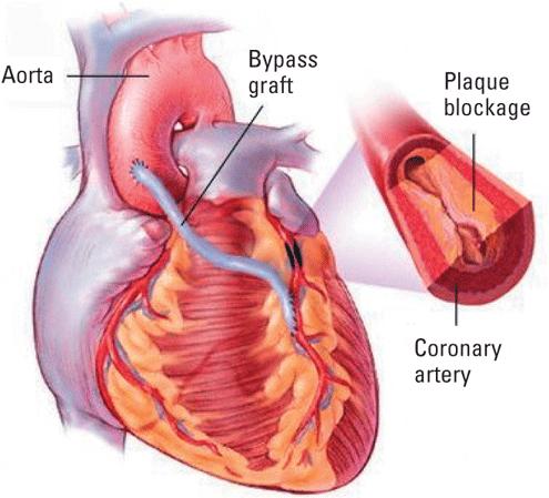 viloangina inom senaste veckorna Behandling Angina pectoris Livsstilsförändringar