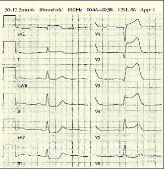 Myoardischemi i infarcerat område med progedierande cellnekros Symptom Central, retrosternal, ofta ihållande bröstsmärta Utstrålning mot hals, käke, axlar eller armar Vegetativa symptom