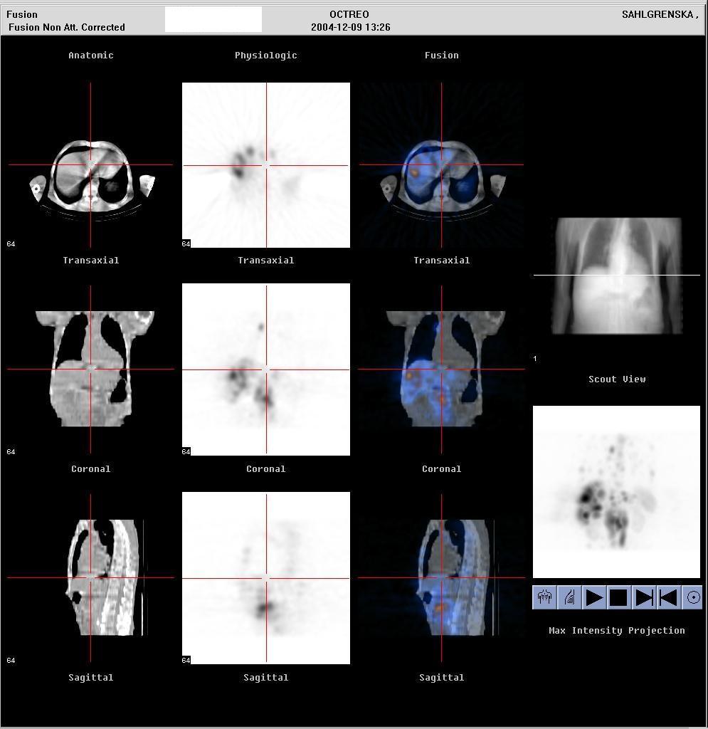 Octreotid