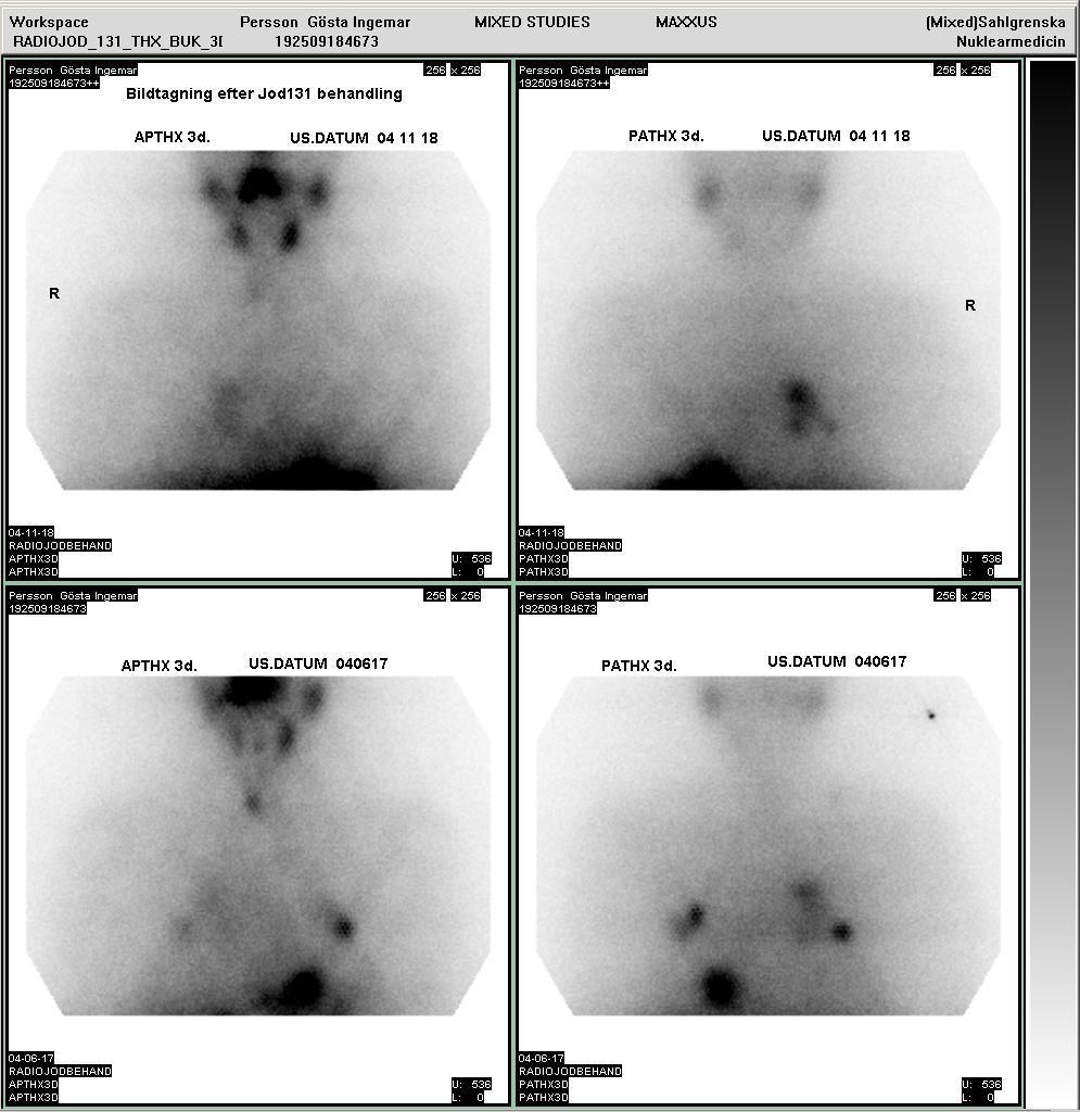 JOD-131 behandling J-131TERAPI GÖRAN PERSSON 2509184673 thxbilder två terapier Bildtagning efter terapidoser 040617 och 041118