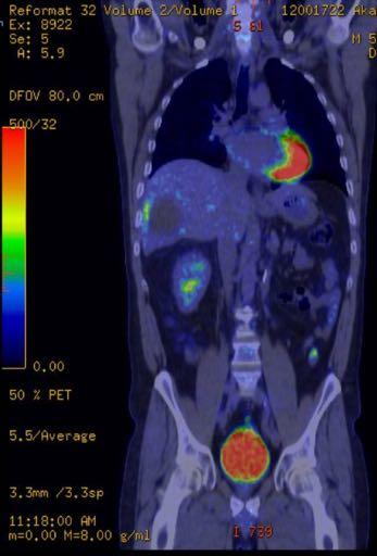 Sutent  njurcancer