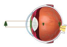 Hjärnan omvandlar sedan dessa elektriska impulser till bilder. Myopi (närsynthet) Personer som är närsynta ser bra på nära håll, men har svårt att tydligt se saker på avstånd.