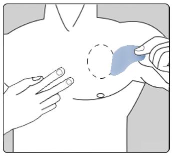 på höger sida av kroppen en dag, på vänster sida nästa dag, på övre delen av kroppen en dag, på undre delen av kroppen nästa dag). Sätt inte ett nytt plåster på samma hudyta två gånger inom 14 dagar.