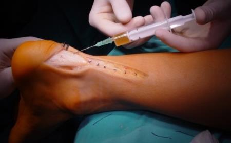 injektion förkortade ej ÅTI för idrottare med allvarlig akut hamstringsskada.