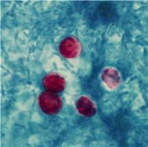 Cryptosporidiumcystor Amöbainfektion: Sjukdomstillståndet orsakas av en parasit, Entamöba histolyca, och infektionen brukar även kallas amöbadysenteri.