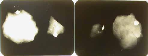 Lerpreparatet röntgades och då syntes, vad som såg ut som två små, runda metallföremål, en i vardera lerklumpen.