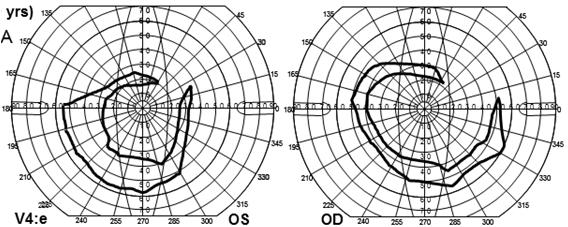 ar Retinitis pigmentosa ar Retinitis pigmentosa