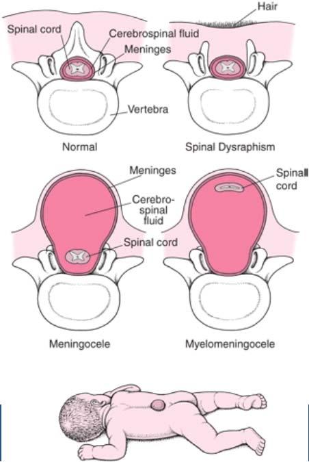 4 olika former av defekter 3 Det nyfödda barnet med ryggmärgsbråck Transport till