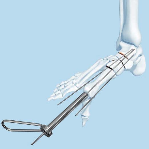 Implantation 1a Införande av styrstiftet Instrument 292.680 Styrstift, B 2.8 mm 312.