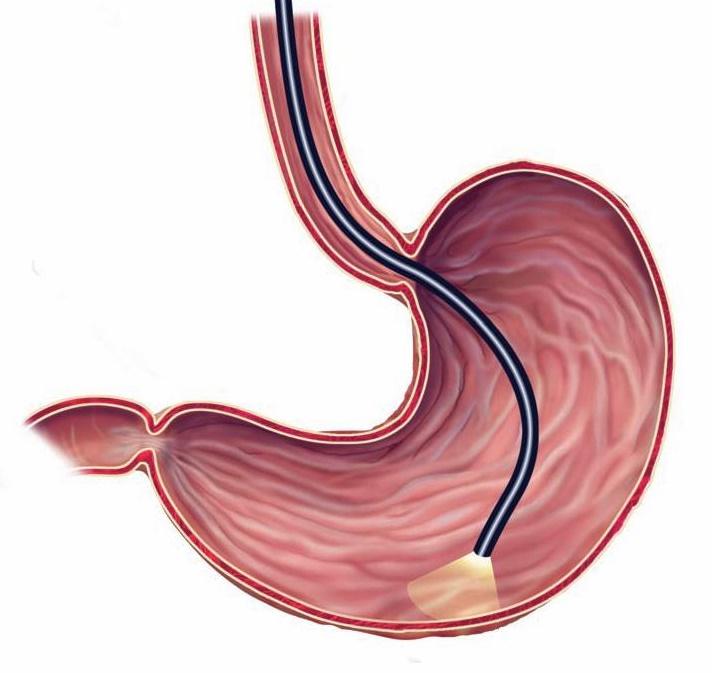 ENDOSKOPI & BIOPSI Flexibel endoskopi en av världens vanligaste