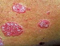Skin Diseases (http://www.niams.nih.