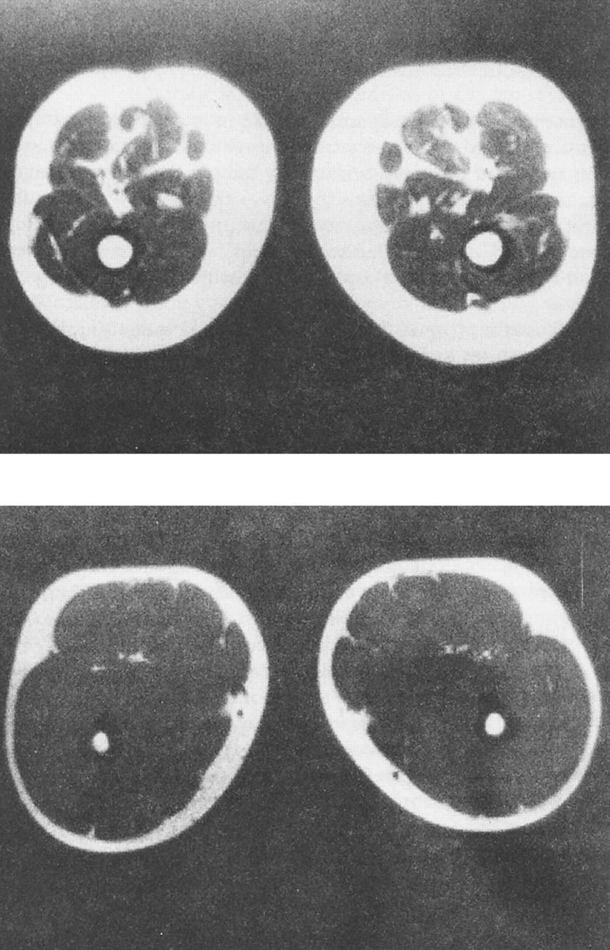 Thigh MRI of an old vs young woman Äldre kvinna Yngre kvinna Rosenberg I H J. Nutr.