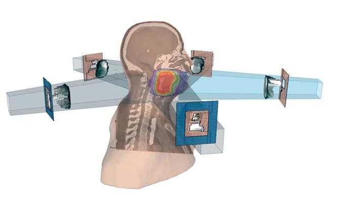 Genom direkt och simultan optimering av samtliga VMAT-parametrar erhålls behandlingsplaner med oöverträffad kvalitet.