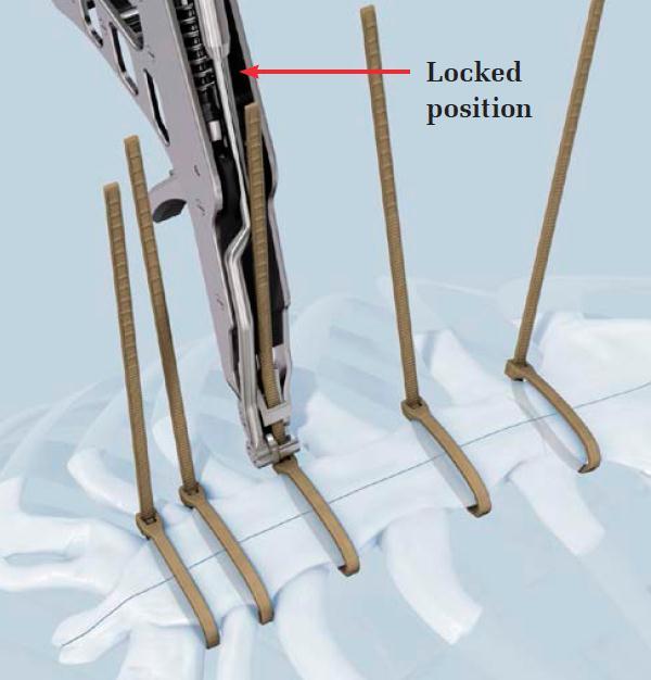 Tabell 1 Uppdaterad operationsteknikguide till Sternal ZipFix TM Detaljerade bilder visar skärspakens position när den är låst och olåst. En pil visar Låst position.