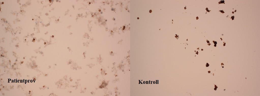 Immuncytokemisk infärgning Resultat av infärgning med anti-cd20 enligt LBC utföll ojämnt med varierande intensitet hos cellerna i patientprov och kontrollmaterial.