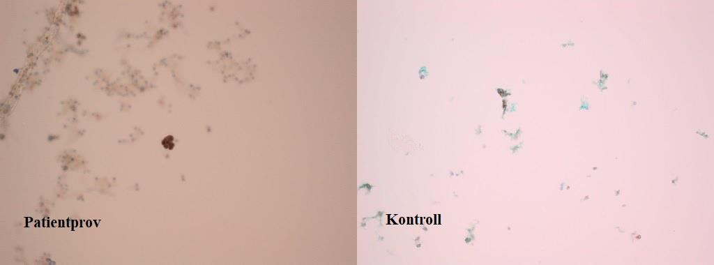 Exempel på en framgångsrik infärgning med anti-wt1 enligt LBC av patient 5: patientprov bedömt ++, kontrollmaterial bedömt +++ (vit pil). Här syns den gröna markörfärgen i kontrollen (vit pil).