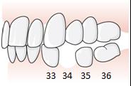 105 (169) När omfattningen av en betthöjning ska visas med foto eller modell är det bra att veta att avståndet mellan framtänderna i fronten alltid är större än mellan tänderna i sidopartierna