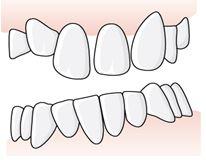 ersättningsberättigande för att etablera fungerande artikulation när det föreligger ett avvikande ocklusionsplan. Artikulation innebär att tänderna i underkäken kan glida i sidled och framåt. 6.5.3.