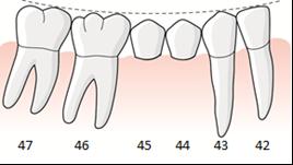 Planerad behandling innebär tandstödda broar 16 23 och 44 33, där 15 och 22 är bräckliga stöd, samt enstaka kronor på 24, 25 och 36 på grund av karies och frakturer.