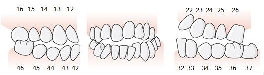 114 (169) det finns tre ockluderande tänder på höger sida (16 och 15 mot 46) och ett ockluderande tandpar mellan 26 och 36 på vänster sida.
