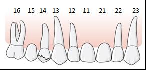 I villkoren framgår att ny konstruktion ersätts enligt respektive tillstånd för tandlöshet när reparation inte kan utföras.