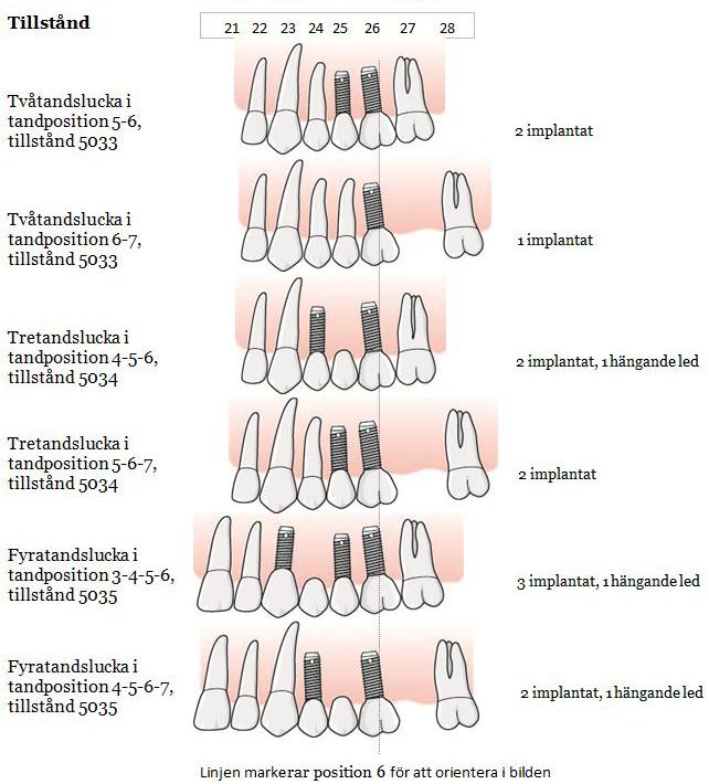 124 (169) Bild, implantat i två-, tre- och fyratandsluckor som involverar tandposition 6 Bilden visar det maximala antalet implantat som är ersättningsberättigande för respektive tandlucka inom samma