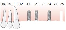 142 (169) När friläggning och distansanslutning sker konstaterar tandläkaren att uttalad marginal benförlust föreligger för implantaten i position 11 och 25.