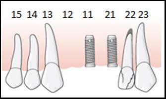 I vänster överkäke har patienten en bro 2123 för en saknad 22, övriga tänder 2427 finns. Strax innan det är dags för distansanslutning känner patienten ömhet i tanden 21.