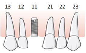 151 (169) Implantatkronorna utförs på individuella distanser som skruvas fast separat och tandläkaten rapporterar åtgärd 858 x 3 inom tillstånd 5448.