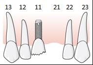 158 (169) 6.7.9.2.4 Exempel, skada på befintlig implantatkrona i en entandslucka och samtidig förlust av granntand En patient har sedan många år ett singelimplantat i tandposition 11.