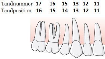 29 (169) 1.5.2.1.1 Exempel, tandnummer och tandposition är inte samma En patient har aplasi av sina permanenta 5:or.