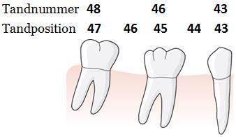 Det innebär exempelvis för den första kvadranten att tand 14 står i tandposition 14, tand 16 i tandposition 15 och tand 17 i tandposition 16. En patient har aplasi av sina permanenta 5:or.