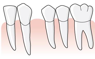 30 (169) Tandläkaren rapporterar tillstånd 4081, Omfattande fraktur eller omfattande förlust av tandsubstans för tandposition 27 och en krona är ersättningsberättigande. Regel D.