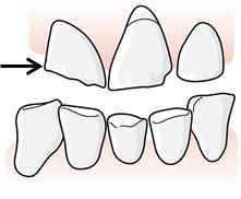 72 (169) 5.2.1.1 Olika skador på en tand kan inte adderas när en skadas omfattning ska fastställas När omfattningen av en skada ska fastställas måste villkoren för minst ett kriterium enligt regel D.