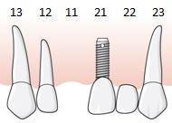 81 (169) 6.3.2 Regel E.12 Befintligt hängande led 6.3.2.1.1 Exempel, hängande led bredvid saknad tand ska likställas med tandlöshet En patient har en bro 22 23 (24). Tänderna 25 28 saknas.