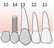 82 (169) 6.3.3.1.1 Exempel, koppling mellan tand och implantat vid friändstandlöshet bakom hörntanden, tillstånd 5012, implantat i tandposition 15 En patient saknar samtliga tänder bakom 13.