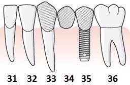 83 (169) 6.3.3.1.3 Exempel, tvåtandslucka där endast ett implantat kan installeras, kopplad konstruktion till granntand utförs En patient har en tvåtandslucka 34 35, tillstånd 5033.