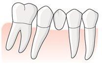 92 (169) Tandläkaren utför en bro mellan 45 och den distala roten av 46. Tandläkaren rapporterar åtgärd 801 för 46 och 45. För det hängande ledet för 46 mesiala del lämnas ingen tandvårdsersättning.