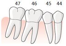 De allmänna råden om den tandlucka som uppkommer efter separerad rot avser endast tillstånd 5031 eller 5036 för entandslucka och kan inte användas vid annat tillstånd.