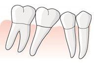 7 Exempel, mesiala roten av tand i position 6 avlägsnas, bro utan hängande led utförs En patient får tid hos sin tandläkare för att avlägsna den mesiala roten på 46 på grund av en djup