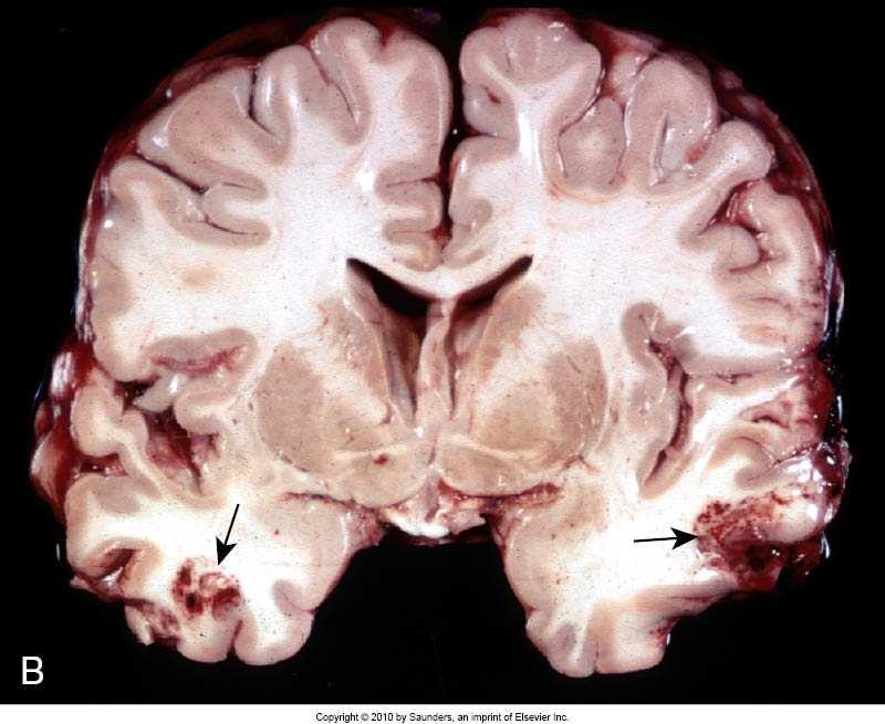 Contusion cerebri Blödningar: Coup och contrecoup. Hjärnan är rörlig.