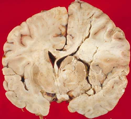 Stroke: Ischemisk hjärninfarkt Stroke: Blödning Täppning av en hjärnartär Atheroskleros/åderförkalkning av hjärnartären Trombos på rupturerad plack Riskfaktorer för åderförkalkning: Blodhögtryck,