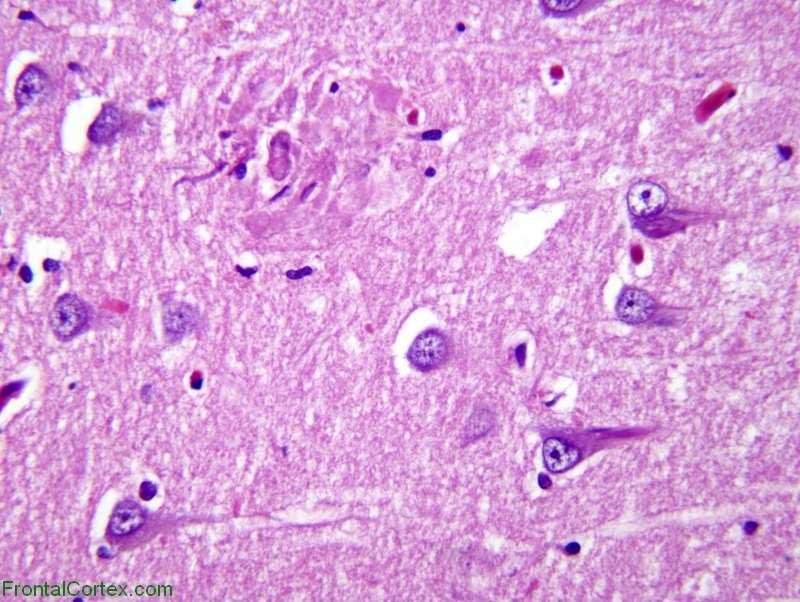 Alzheimers sjukdom Alzheimers sjukdom Mikroskopisk bild: Avlagringar i Alzheimers sjukdom Drabbar cortex/hjärnbarken: Demens Demens: Minskning av intellektuella