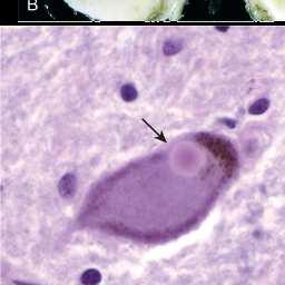 Parkinsons sjukdom Parkinsons sjukdom Lewy kropp: avlagring av αsynuclein (mikroskopisk