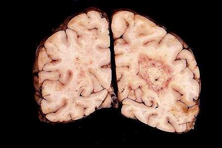 Infektion via infekterad kattavföring eller kött Toxoplasmos: Sjukdom Symptom (fungerade immunförsvar): Feber,